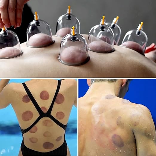 Complete Vacuum Cupping Set with 32 Silicone Cups & Manual Pump
